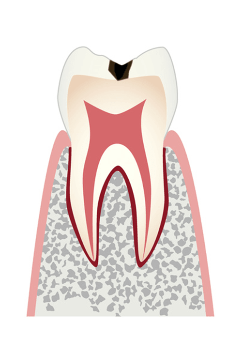 C1（エナメル質内の虫歯）＝初期虫歯