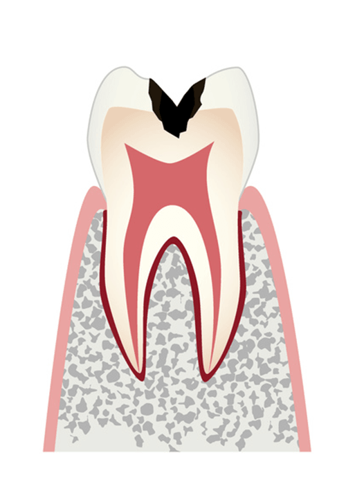 C2（象牙質内の虫歯）＝中等度の虫歯
