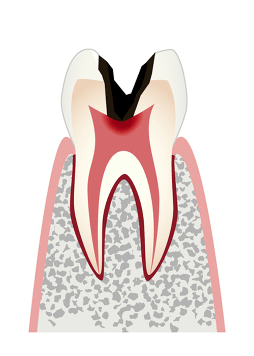 C3（神経が感染した虫歯）＝重度の虫歯