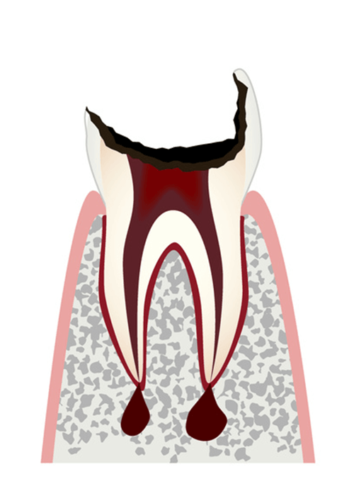 C4（歯がボロボロの虫歯）＝末期の虫歯
