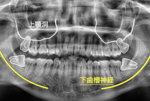 上顎洞炎/下歯槽神経麻痺